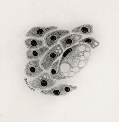 Cellule atipiche in un caso di infestazione del fegato da Cysticercus fasciolaris