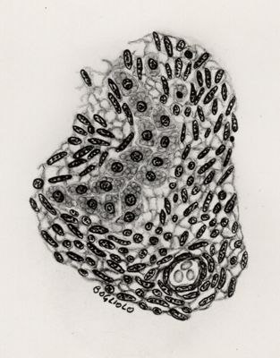 Sarcoma epatico da Cystocercus fasciolaris, isola di cellule normali in tessuto blastomatoso.