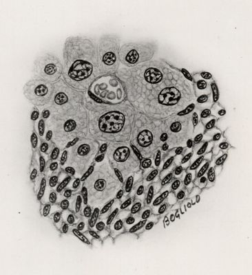 Limiti tra zone sane e zona sarcomatosa (Sarcoma da Cysticercus fascicolaris)