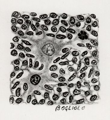 Sarcoma da cisticercus fasciolaris