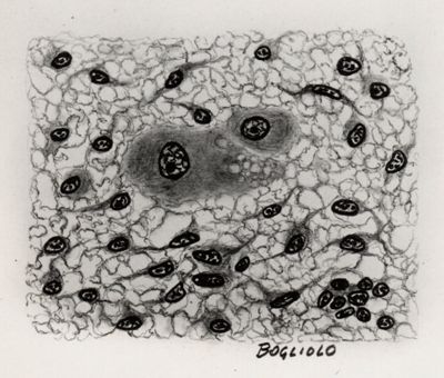 Cellule epatiche in stroma sarcomatosa (infestazione da cysticercus fasciolaris)