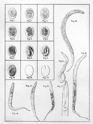 "la malattia dei minatori" Tavole annesse al volume originale di E. Peroncito