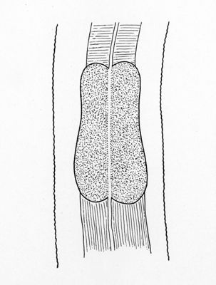 Agamocheilida capsularia. Bullo esofageo