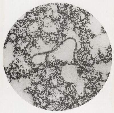 Larva di Anchylostoma libera in alveoli polmonari iperemici