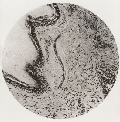Larva errante di Anchylostoma sottoepidermica