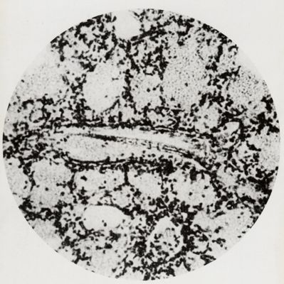 Larva di Anchylostoma in una arteria polmonare