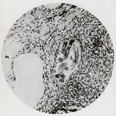 Vaso linfatico peri-ghiandolare ripieno di larve di Anchylostoma