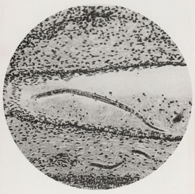 Larva di Anchylostoma in un vaso venoso sottocutaneo