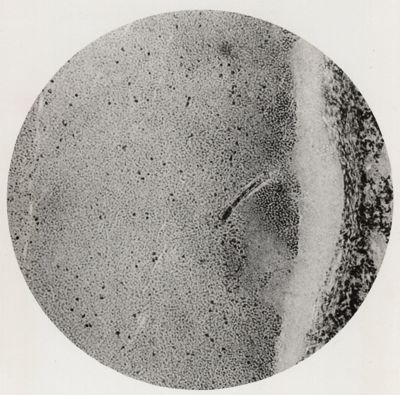 Larva di Anchylostoma in una vena polmonare