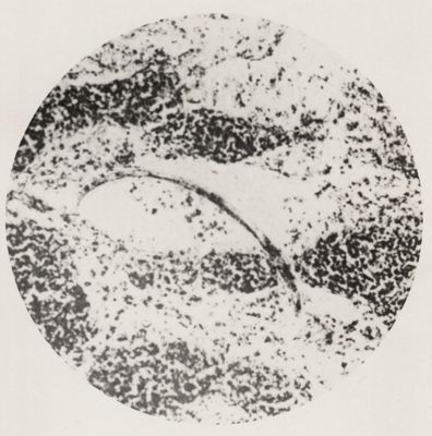 Passaggio di una larva di Anchylostoma da un vaso a una ghiandola linfatica