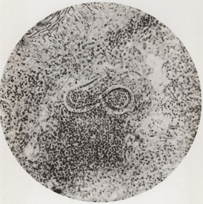 Larva di Anchylostoma in una ghiandola linfatica