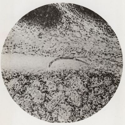 Larva di Anchylostoma in un vaso linfatico polmonare