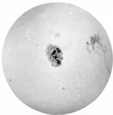 Trypanosoma gambiense - grossa forma a Leptomonas  in divisione multipla (forma a rosetta)