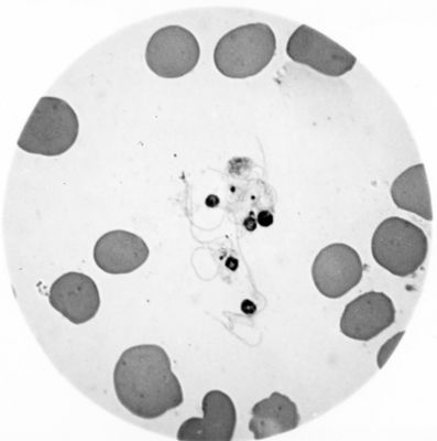 Trypanosoma gambiense - forme a Leptomonas  prodotte, evidentemente, dalla divisione multipla forma a rosetta