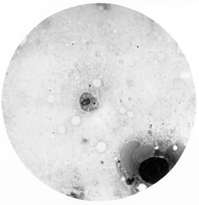 Trypanosoma gambiense - forma a Leishmania nel midollo delle ossa