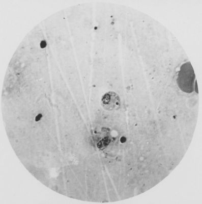 Trypanosoma gambiense - forma a Leishmania nel midollo delle ossa