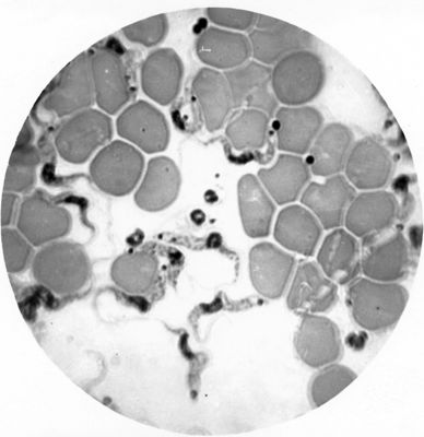 Trypanosoma gambiense - forme a Leishmania nel sangue circolante