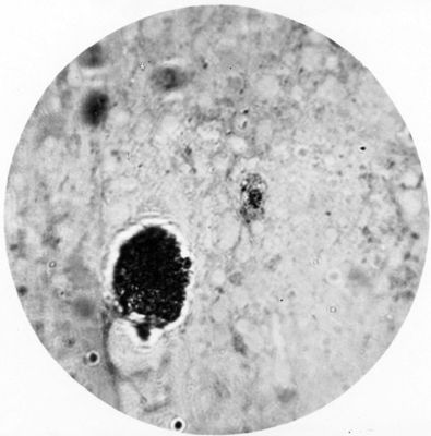 Trypanosoma gambiense - forma a Leishmania in uno striscio di midollo spinale