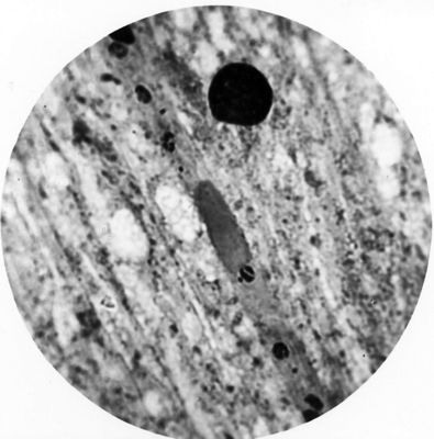 Trypanosoma gambiense - forme a Leishmania che embolizzano un capillare cerebrale