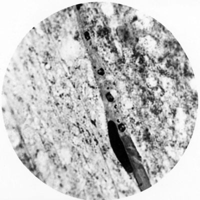 Trypanosoma gambiense - forme a Leishmania anche in divisione (notare a destra dell'osservatore i blefaroblasto in amitosi) nell'interno di un capillare cerebrale