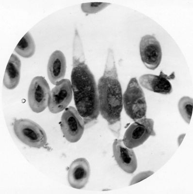 Tre Leucocytozoon in diverso stadio di sviluppo