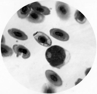 Leucocytozoon rotondeggiante con nucleo provvisto di carioroma a granulo cromatinico