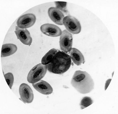 Leucocytozoon rotondeggiante provvisto di tre nuclei