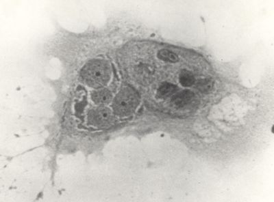 Fenomeno citopatologico da virus