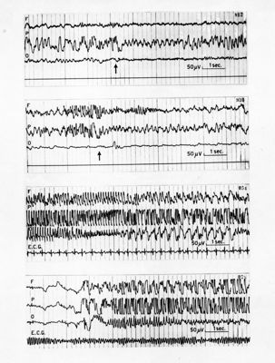 Fotomontaggio delle quattro tavole riguardanti l'Elettroencefalografici di prove farmacologiche sulla idrazide dell'acido isonitinico
