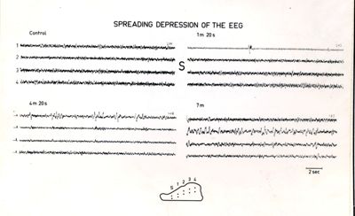 Immagini che ritraggono l'andamento degli EEG