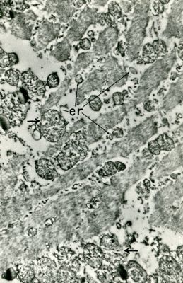 Tessuto muscolare che presenta evidenti degenerazioni strutturali