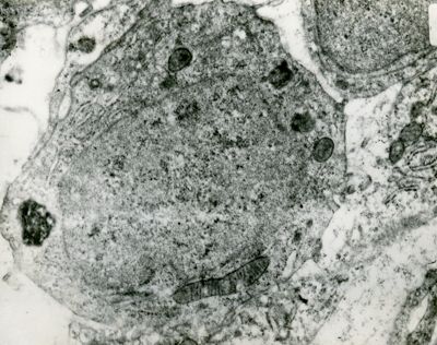 Cellula con grosso nucleo con alterata distribuzione della cromatina, riferibile probabilmente ad infezioni virale