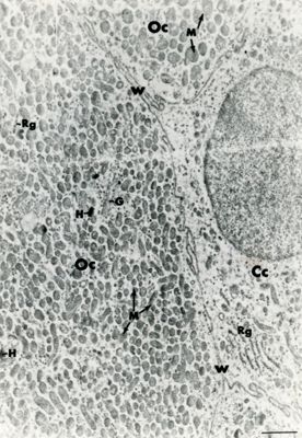 Particolare di un tessuto che mostra porzioni di tre cellule adiacenti. La cellula di destra mostra un nucleo ben preservato e citoplasma rarefatto mentre le porzioni delle altre due cellule mostrano citoplasmi particolarmente ricchi di mitocondri ed altri organuli citoplasmatici