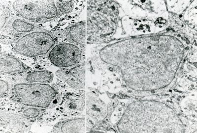 Sezione di tessuto o di monostrato di cellule in coltura osservato a due diversi ingrandimenti. Le cellule che lo compongono hanno grandi nuclei e scarso citoplasma