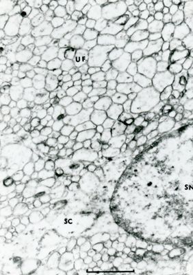 Particolare di una cellula sebacea in cui sono visibili una parte del nucleo ed il citoplasma pieno di gocce lipidiche