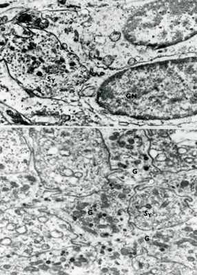 Particolari di nuclei (foto in alto) e porzioni di citoplasma (foto in basso) di un tessuto compatto con cellule molto danneggiate