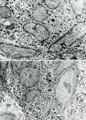 Sezione ultrasottile di tessuto osservata a basso ingrandimento. Le due micrografie mostrano cellule con nuclei eterogenei e numerose inclusioni citoplasmatiche