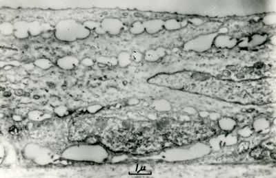 Tessuto stratificato caratterizzato da cellule con nuclei fusiformi e spazi intercellulari vacuolizzati