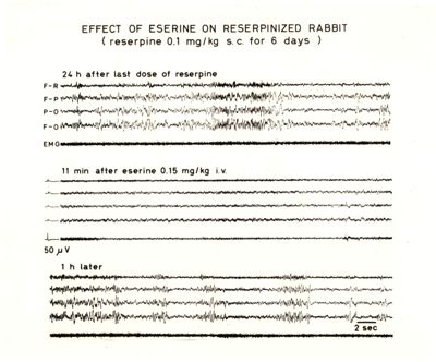 Differenti tipologie di encefalogrammi