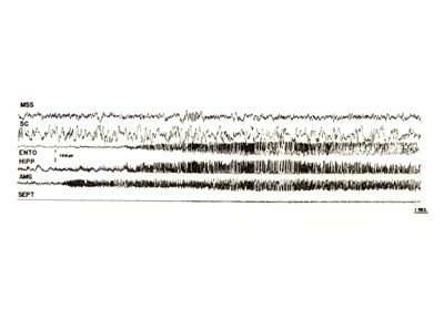 Elettroencefalogrammi e diapositive