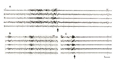 encefalogrammi e grafici