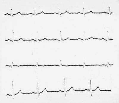 Reperti elettrocardiografici nelle artropatie croniche