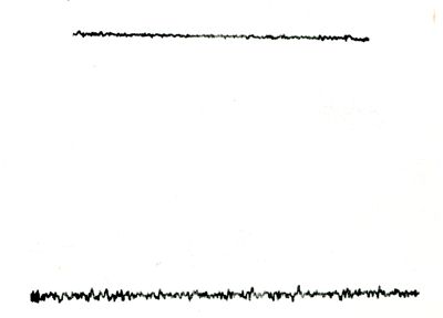 Possibili tracciati EEG