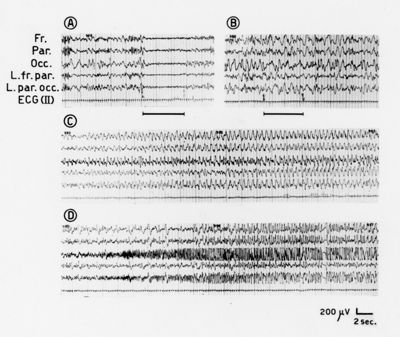 Tracciati elettroencefalografici di coniglio ed effetto dell'istamina nel ratto