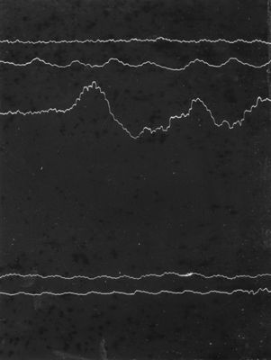 Diagramma della pressione sanguigna pneumoanemizzatore