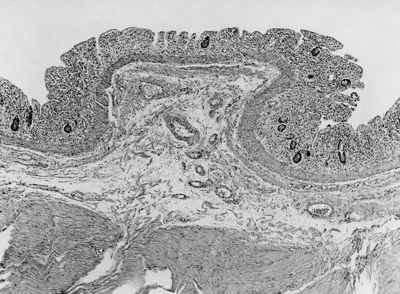 Intestino umano - parete intestinale con erosione parziale della mucosa