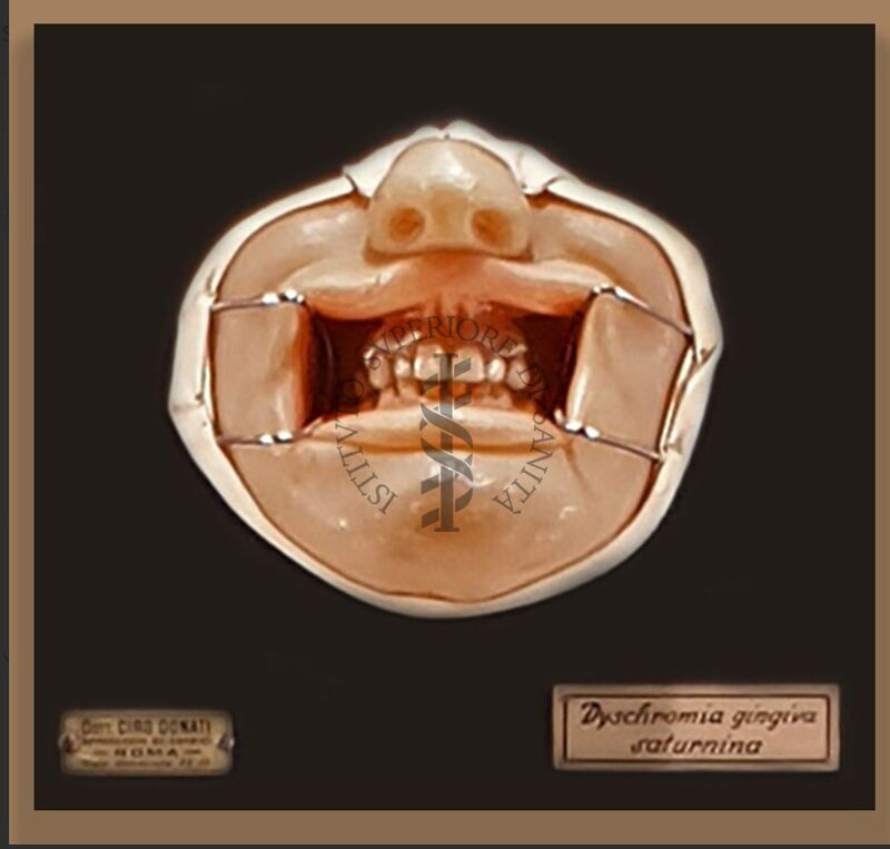 Modelli anatomici in cera CERA SU LEGNO RAFFIGURANTE VOLTO AFFETTO DA  " DYSCOMIA GINGIVA SATURNINA "