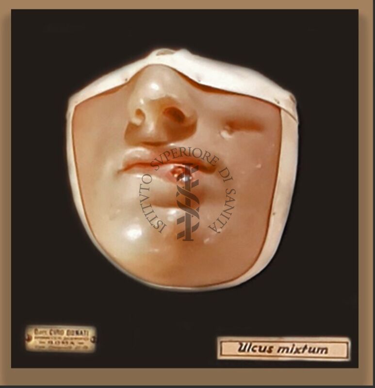 Modelli anatomici in cera CERA SU LEGNO RAFFIGURANTE VOLTO   AFFETTO DA  ULCUS MIXTUM