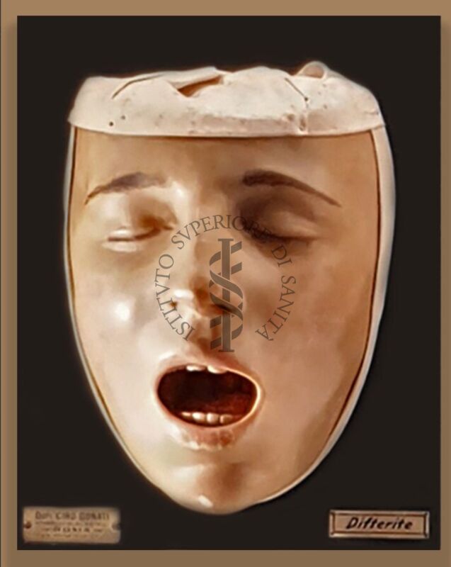 Modelli anatomici in cera CERA SU LEGNO RAFFIGURANTE VOLTO AFFETTO DA DIFTERITE