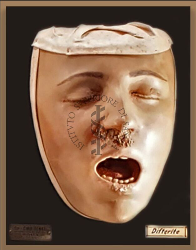 Modelli anatomici in cera CERA SU LEGNO RAFFIGURANTE VOLTO AFFETTO DA DIFTERITE